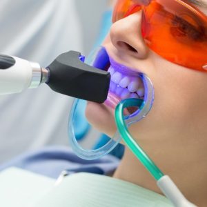 Laser Teeth Whitening with New Equipment