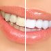 Teeth Whitening- Get A Pearl White Smile