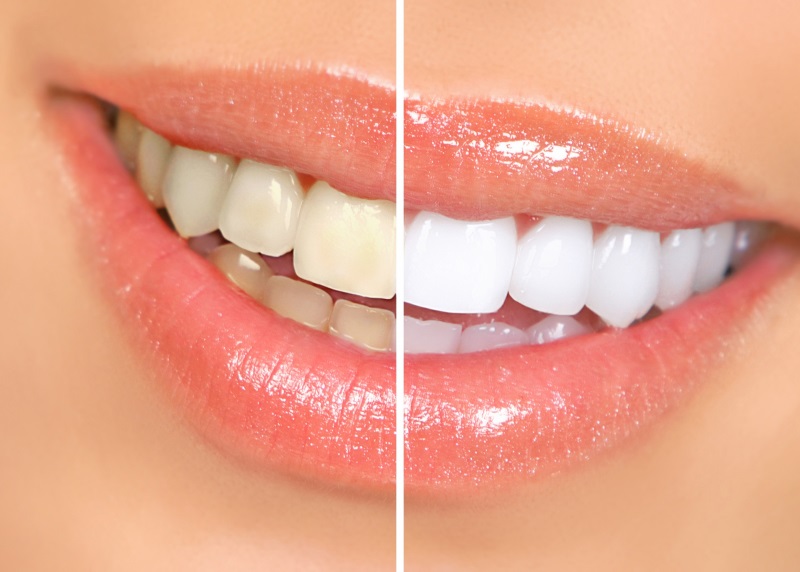 Teeth Whitening- Get A Pearl White Smile