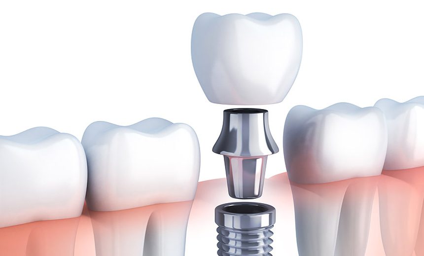 DENTAL IMPLANTS- A BOON FOR THOSE WITH MISSING TEETH!
