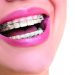 Orthodontic Treatment- Beautifying Your Smile, The Natural Way!
