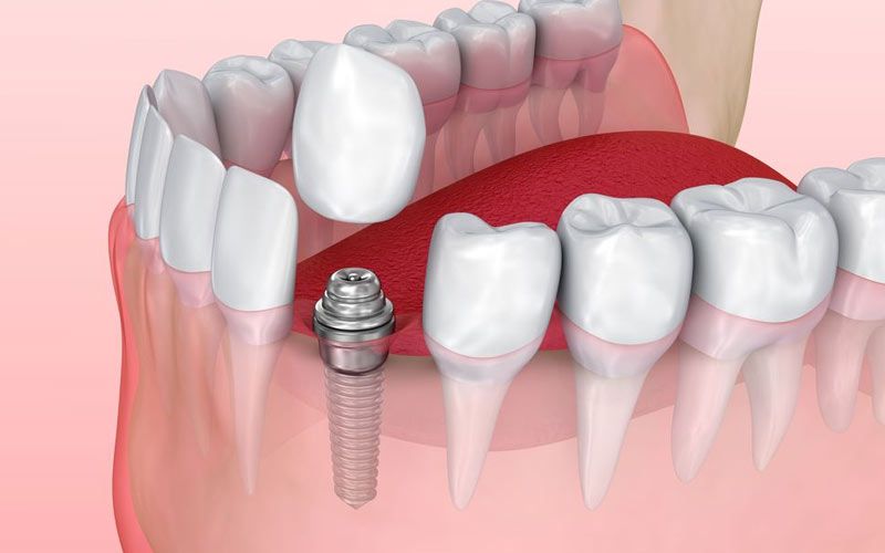 Perfect Dental Implants in Udaipur with Dr Saurabh’s Dental Clinic & Implant center