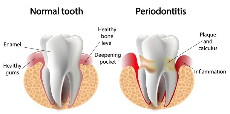 Gum Hygiene in udaipur, Tender Gums treatment, Gums pain remedy in udaipur, gums treatment, laser treatment for gums in udaipur, periodontist clinic in udaipur, Bleeding gums treatment in udaipur, treatment for bleeding gums in udaipur, receding gums treatment, treatment for receding gums in udaipur, periodontal surgery, periodontal surgeon in udaipur, Gum disease expert in udaipur