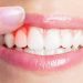 Gum Disease And Their Solutions