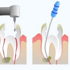 Root canal treatment (RCT)- all you need to know!