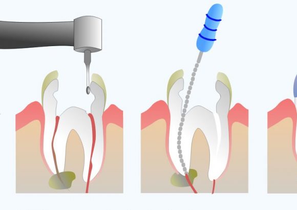 Root canal treatment (RCT)- all you need to know!