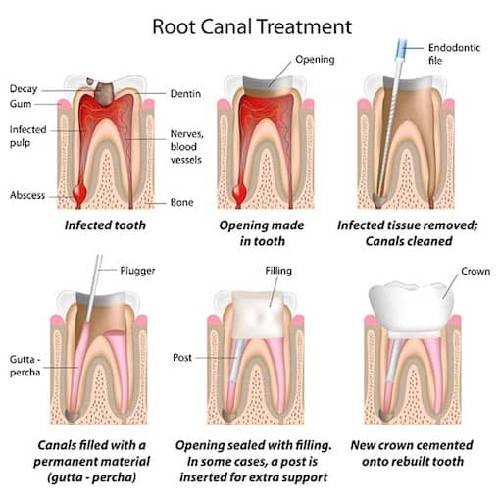 root canal treatment in udaipur, RCT in udaipur, Dental services in udaipur, dentist in udaipur, Root Canal Treatment